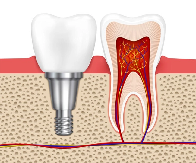 Implantat