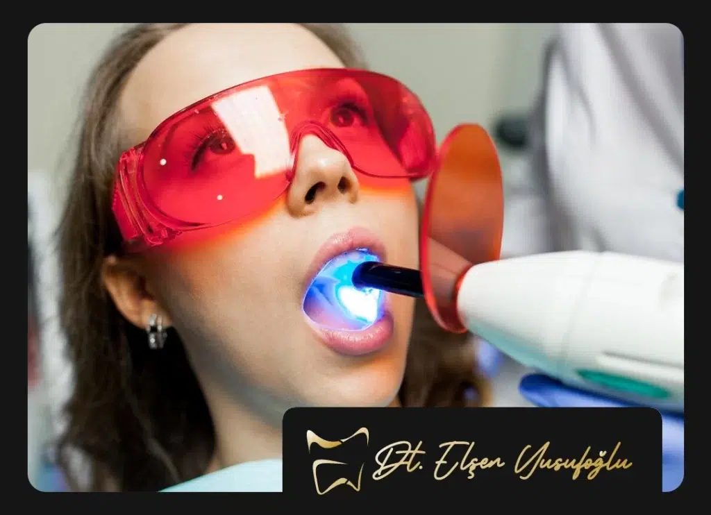 Ankara Diş Beyazlatma Tavsiye