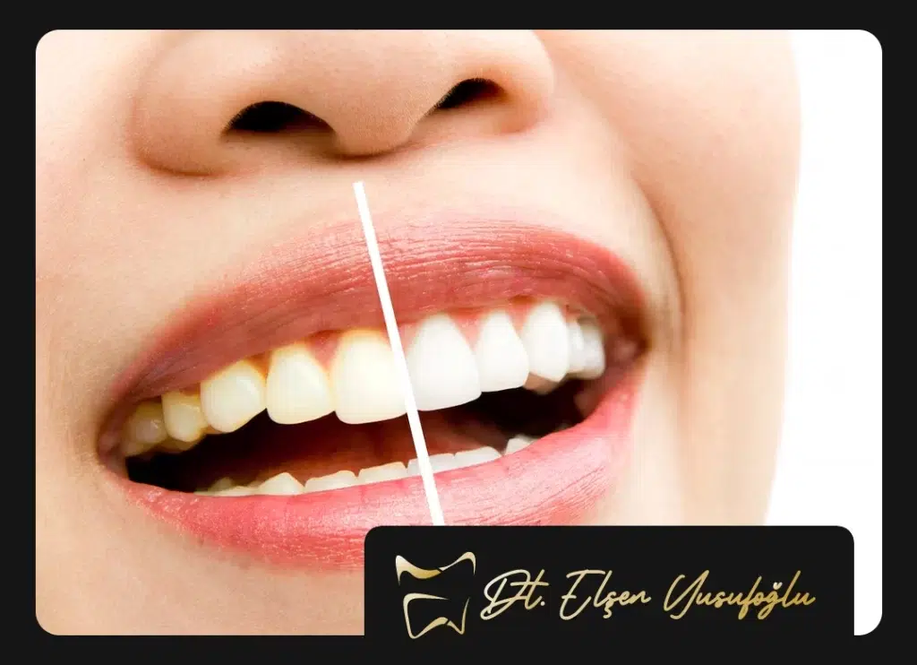 Diş Beyazlatma Fiyatları 2025