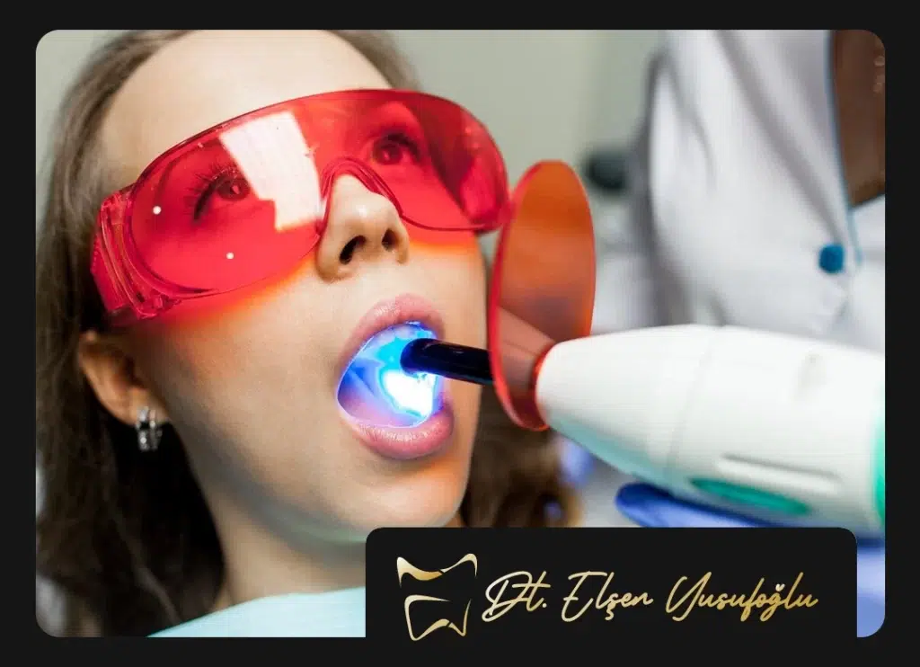 Lazerle Diş Beyazlatma Fiyatları Ankara