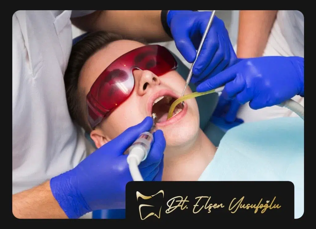 Root Canal Treatment Fees in Ankara